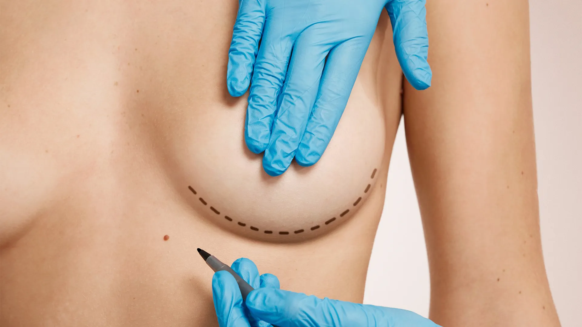 Breaast Augmentation