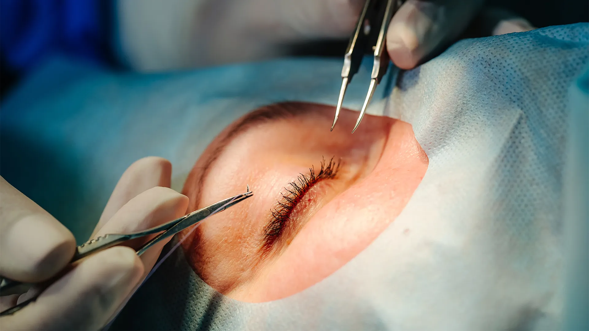 Eyelid surgery