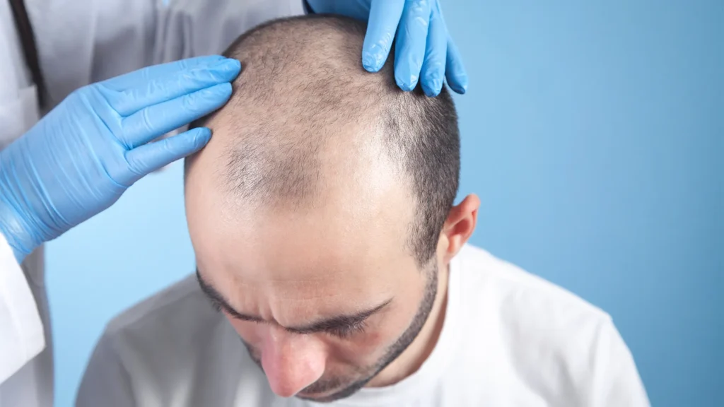 Hair Transplant