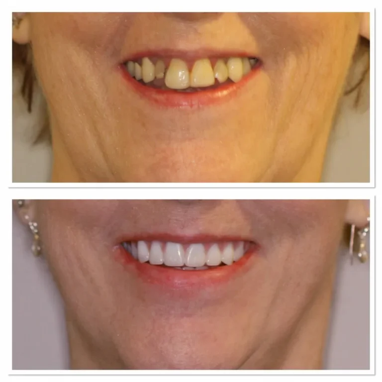 Dental Before and After Female