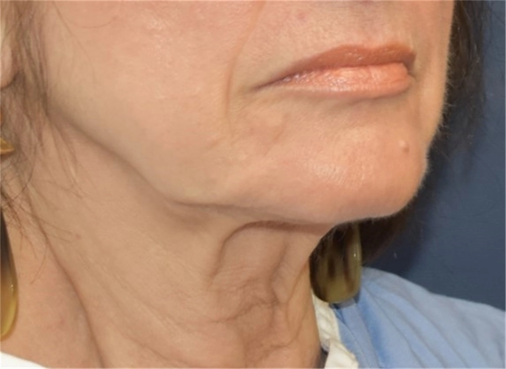 Face and browlift female 1 before