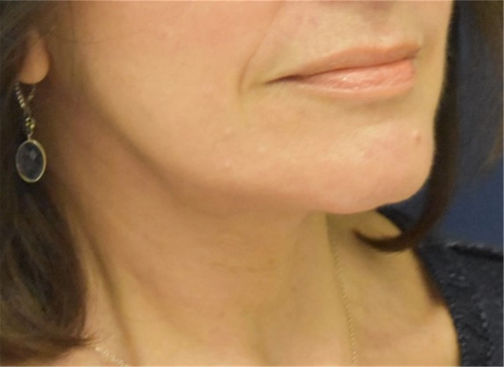 Face and browlift female 1 after