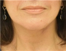 Face and browlift female 4 after