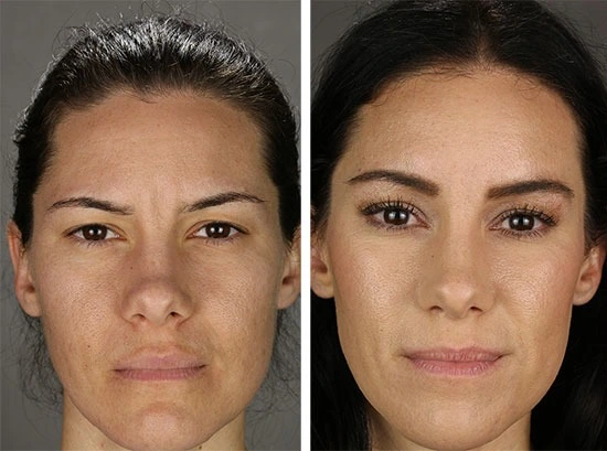 Face and browlift female 5