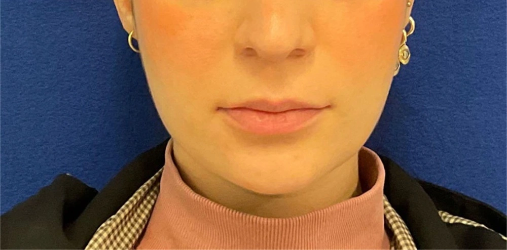 Anti aging botox and fillers female 1