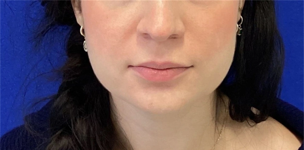 Anti aging botox and fillers female 2