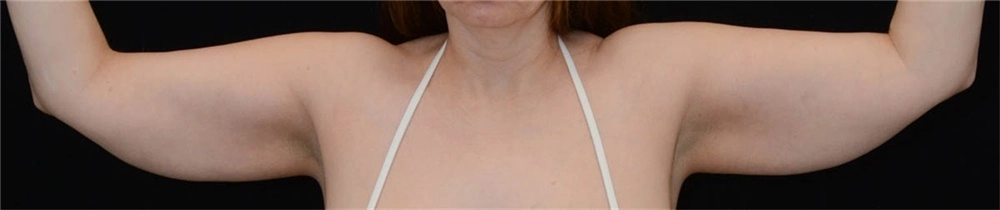 Arm contouring female 1