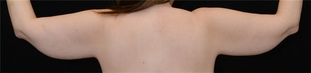Arm contouring female 2