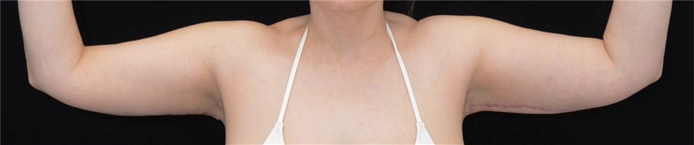 Arm contouring female 3