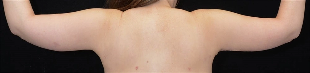 Arm contouring female 4