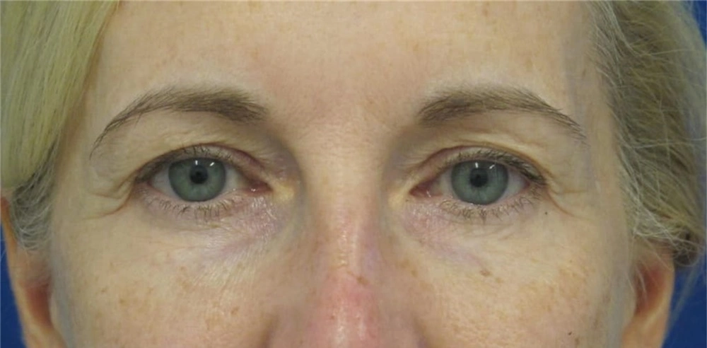 Blepharoplasty eyelids 1