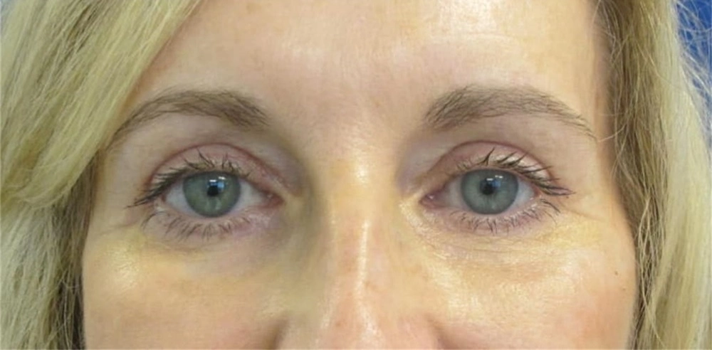 Blepharoplasty eyelids 2