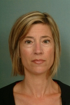 Blepharoplasty eyelids 3