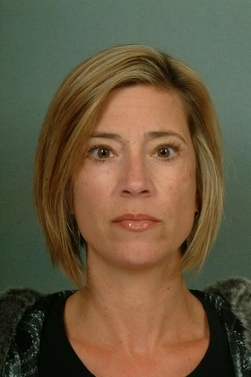 Blepharoplasty eyelids 4