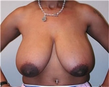 Breast Reduction female before