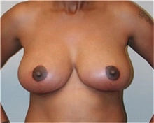 Breast Reduction  female After