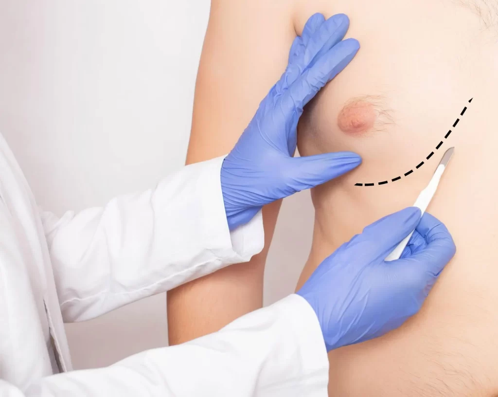 Breast reduction male cover