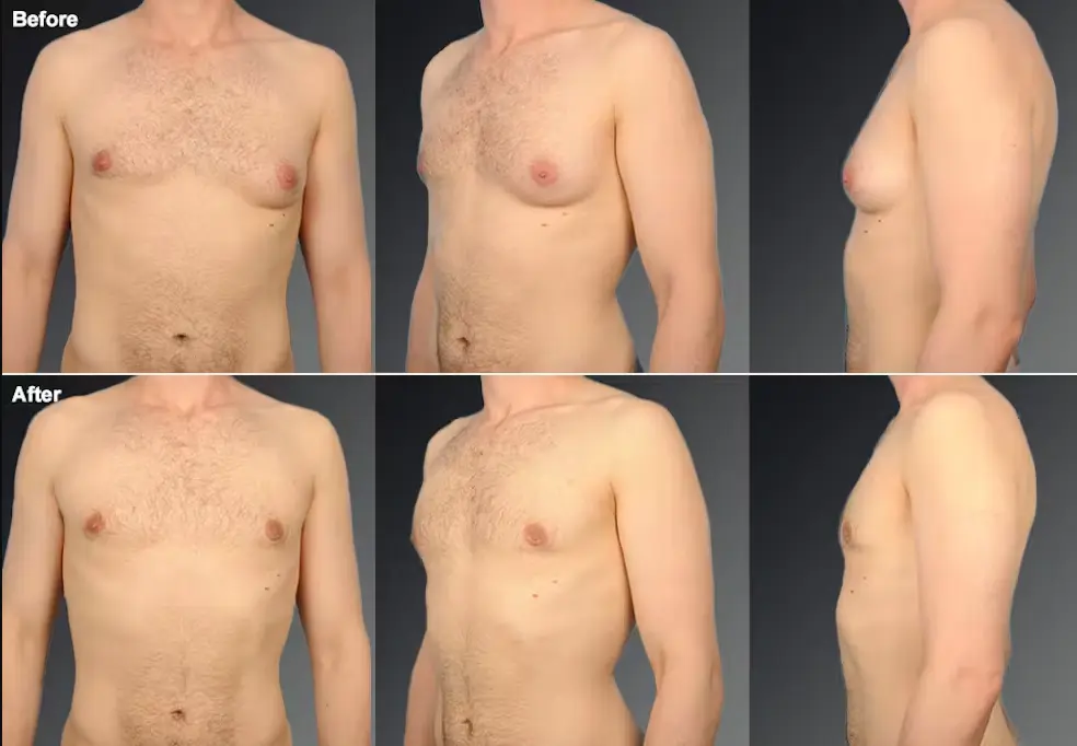 Breast reduction male 2