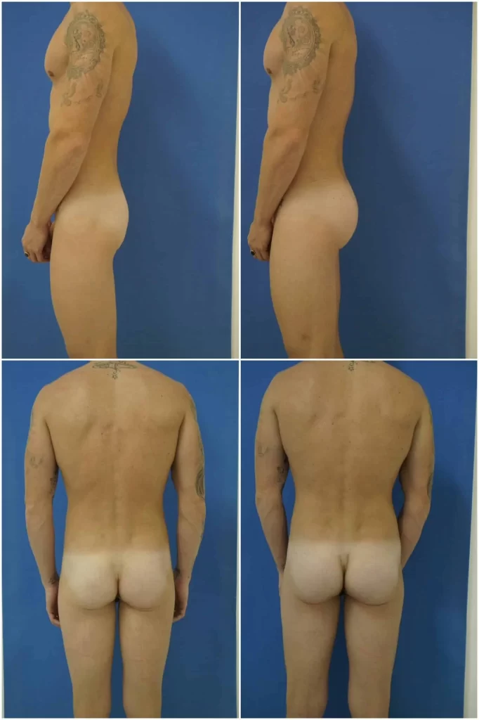 Buttock enhancement male 2