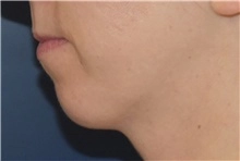 cheek and chin implant female before