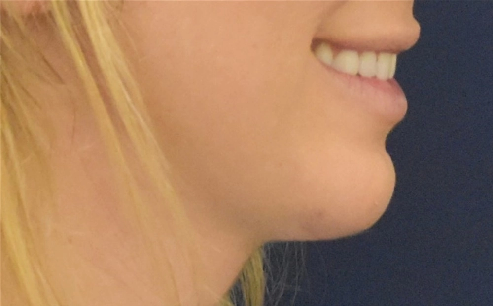 cheek and chin implant female after