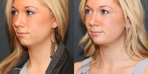 Cheek and Chin Implant female
