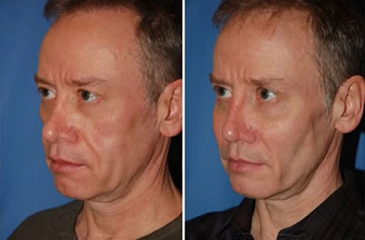 Cheek and chin implant male 3