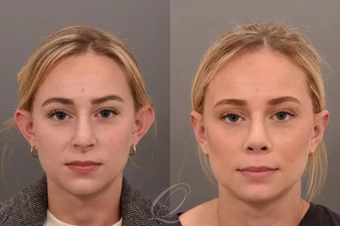 Ear reshaping female 2