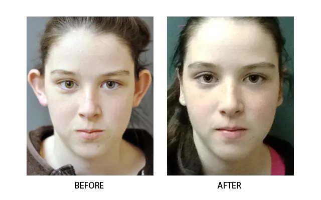 Ear reshaping female 3