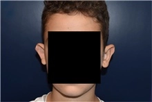 Ear reshaping male 2