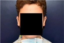 Ear reshaping male 3