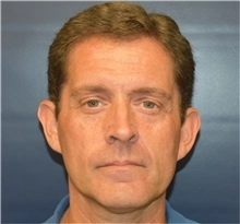 Ear reshaping male 4