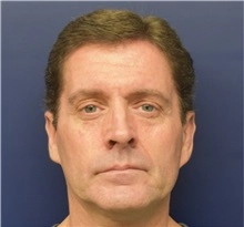 Ear reshaping male 5