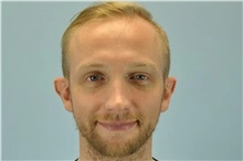 Ear reshaping male 6