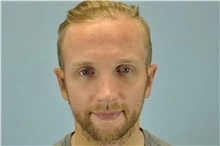 Ear reshaping male 7