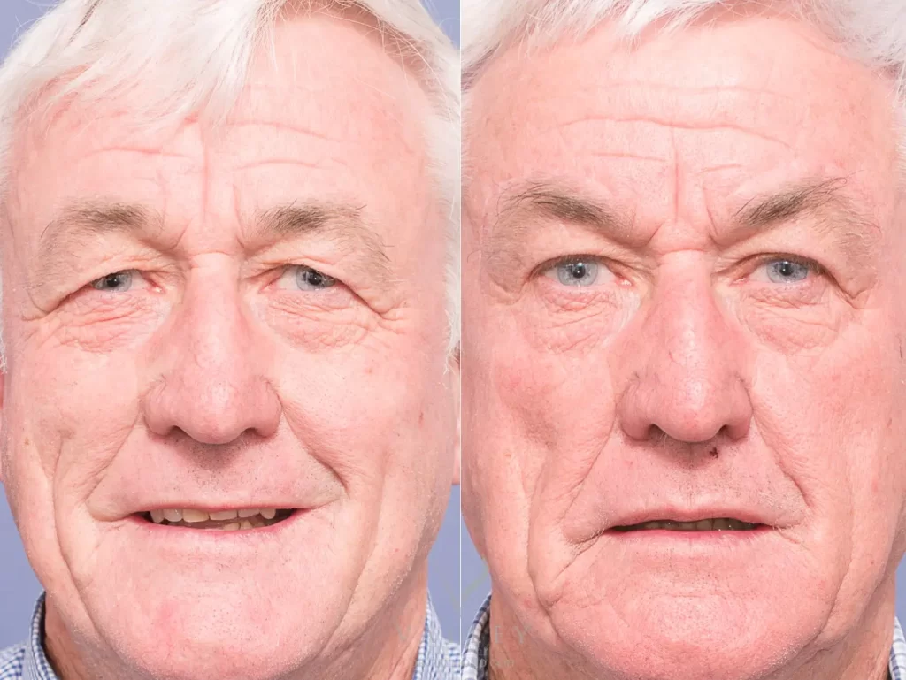 Face browlift male 2