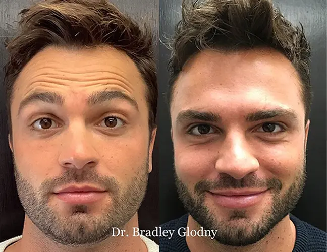 Face browlift male 3