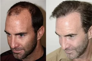 Hair restoration male