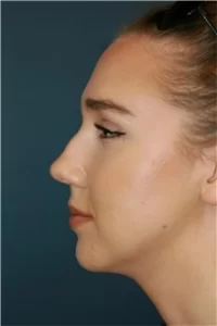 nose reshaping contouring female 1