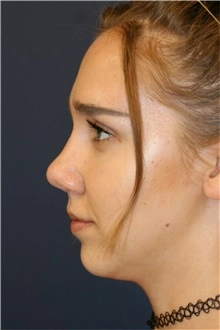nose reshaping contouring female 2