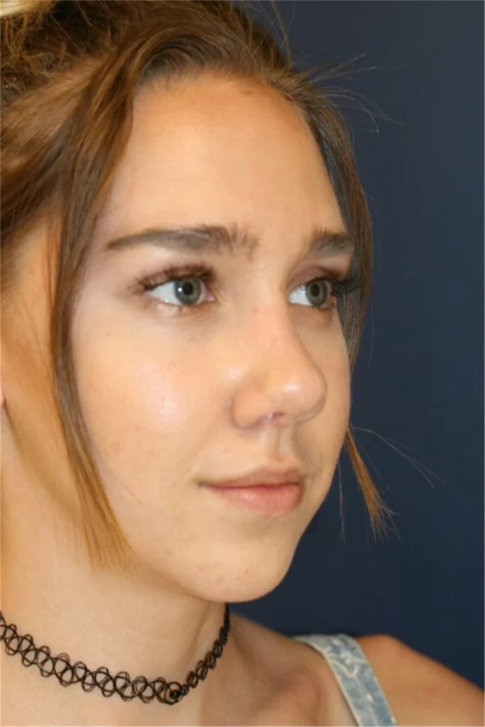 nose reshaping contouring female 3