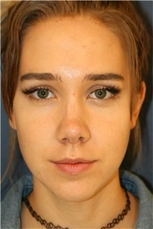 nose reshaping contouring female 5
