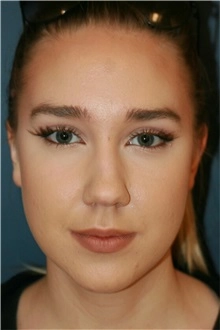 nose reshaping contouring female 6