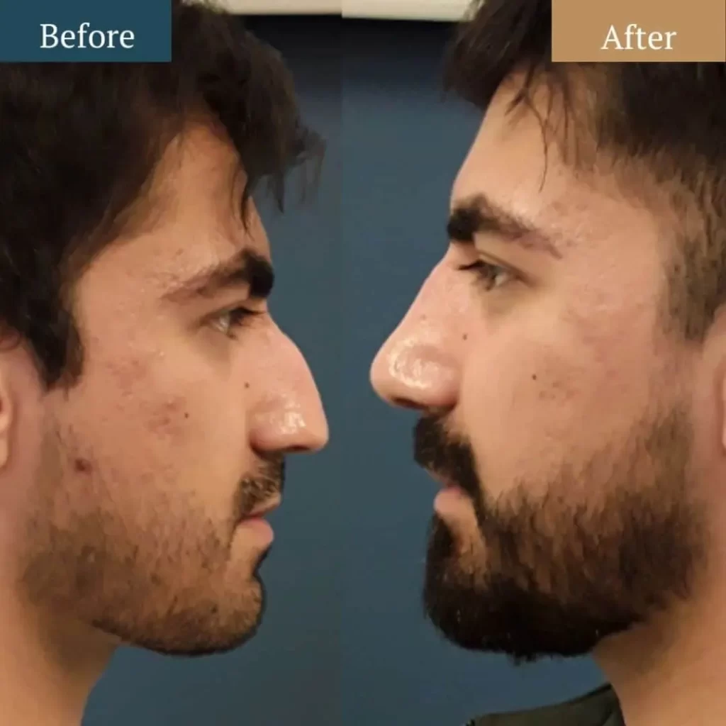 Nose Reshaping Contouring male 1