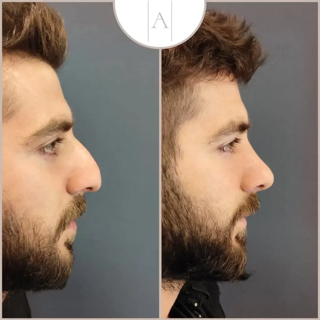 Nose Reshaping Contouring male2