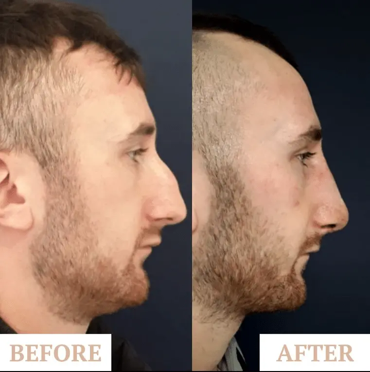 Nose Reshaping Contouring male 3
