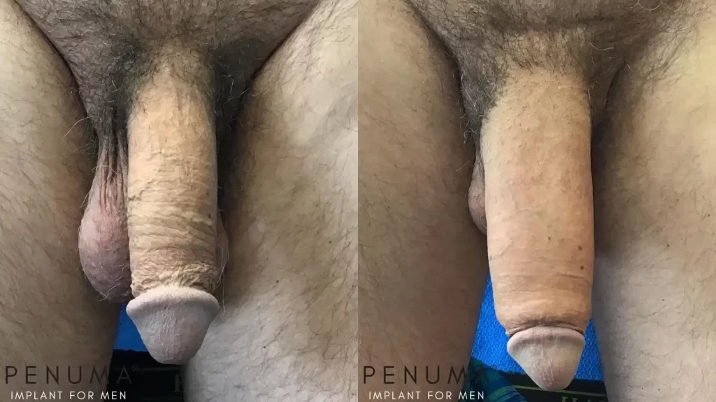 Penile augmentation 2