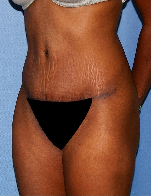 tummy tuck female 1