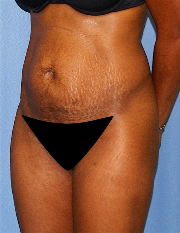 tummy tuck female 2