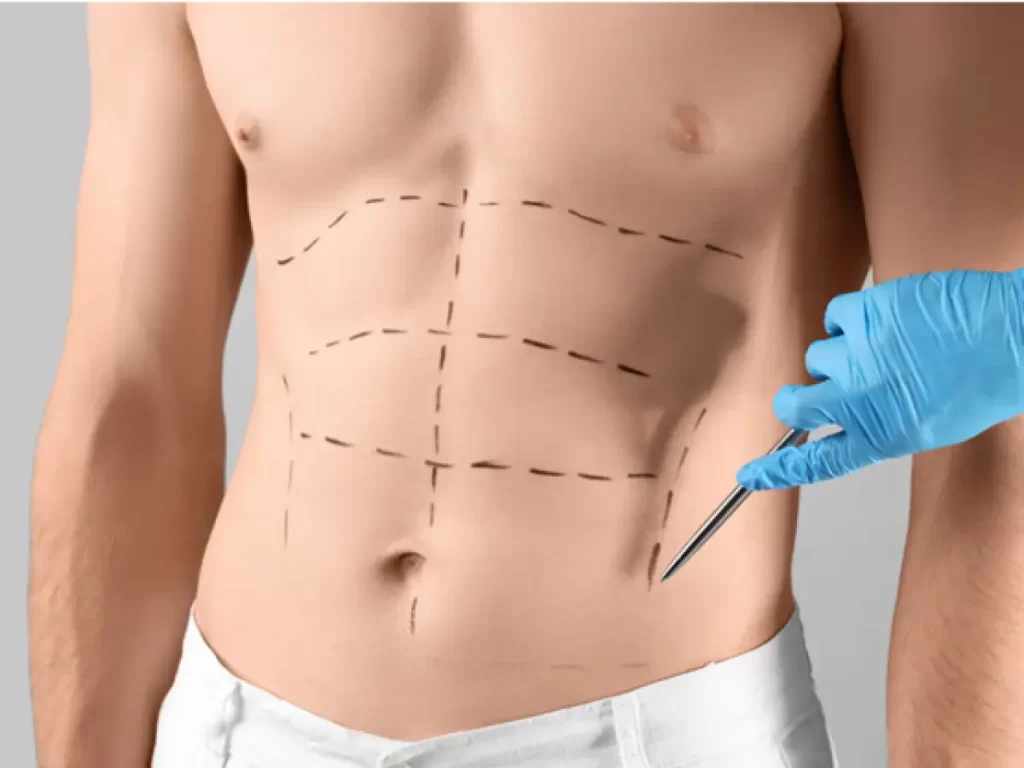 Tummy Tuck male cover